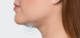 Women's chin in profile Kybella