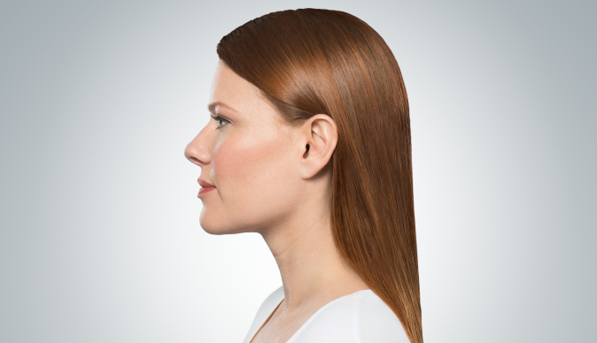 Side profile of a woman before Kybella treatment